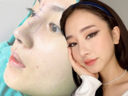 Làm đẹp - Công nghệ nâng mũi giờ đã khác, ai đang có ý định thẩm mỹ, đọc ngay bài viết này!