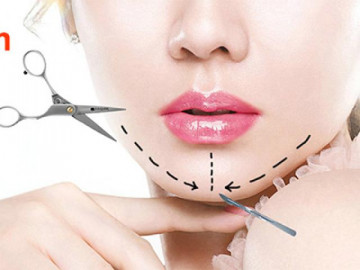 Độn cằm V Line là gì? Độn cằm có đau và nguy hiểm không?