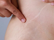 Cách trị rạn da hiệu quả tại nhà làm mờ vết rạn nhanh chóng