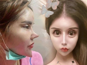 Người phụ nữ trẻ gây hoang mang vì phẫu thuật thẩm mỹ quá đà