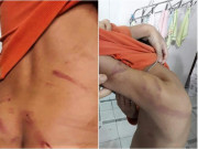 Tin tức - Bé lớp 1 bị bố bạo hành vì học chậm tiến bộ, vết thương chằng chịt ai cũng xót xa