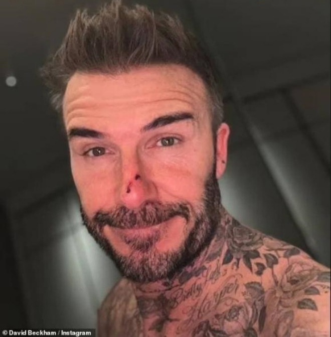  Beckham với chiếc mũi đổ máu.