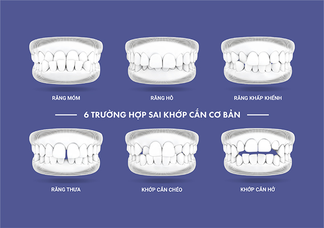 Thời điểm vàng để niềng răng cho trẻ - làm thế nào để giúp con niềng răng “dậy thì thành công”? - 3