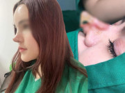 Làm đẹp - Ham chạy theo mốt mũi bay Trung Hoa, chị em ngậm ngùi xin rút sụn