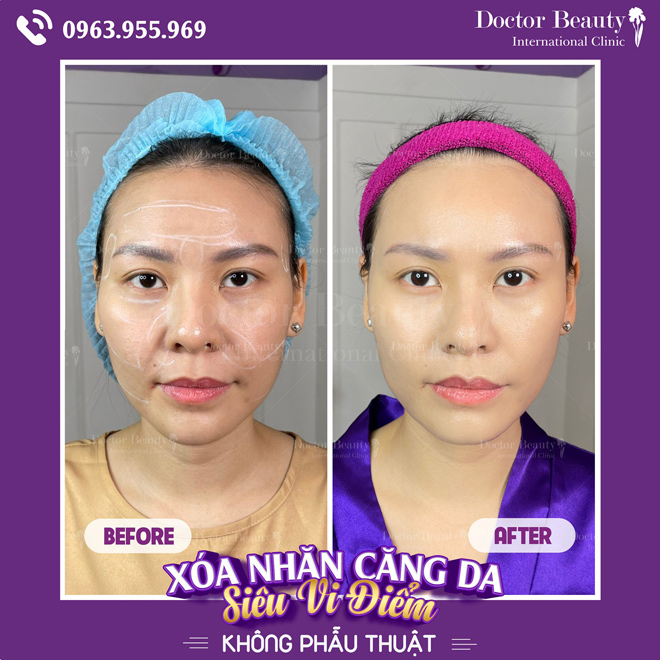 Xóa nhăn siêu vi điểm khẳng định thương hiệu Doctor Beauty International Clinic - 2