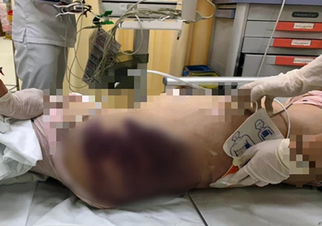 Những vết bầm lớn được xác định xuất hiện trên cơ thể bé gái 8 tuổi khi nhập viện.