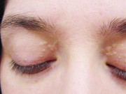 Sức khỏe - 6 dấu hiệu trên mặt cứ tưởng chẳng sao nhưng hóa ra toàn cảnh báo bệnh nguy hiểm