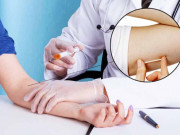 Bà bầu - Những vụ que cấy tránh thai “đi lạc” chạy khắp cơ thể: Sau sinh có nên cấy que?