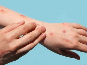 Phát hiện ca đậu mùa khỉ đầu tiên ở TP.HCM: Liệu có thành đại dịch, những ai dễ mắc nhất?