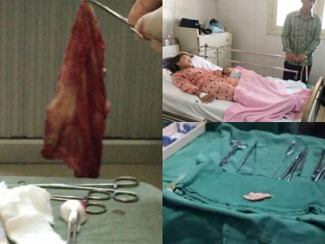 Sau sinh bụng đau dữ dội, sản phụ đi khám bác sĩ lôi ra 1 thứ ngả màu đen từ trong bụng