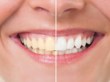 Làm trắng răng có an toàn và đáng “đồng tiền bát gạo”?