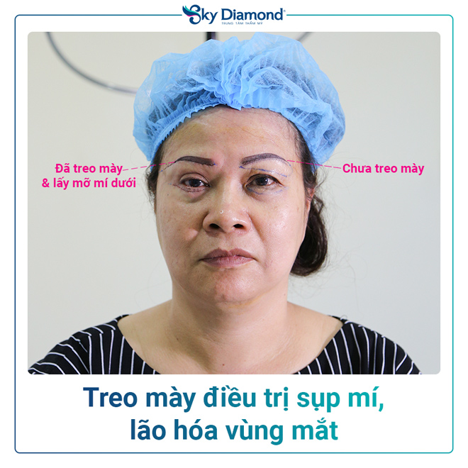 Phụ nữ trung niên nên treo mày hay cắt mí? - 4