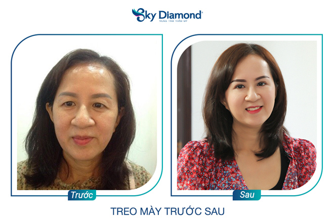 Phụ nữ trung niên nên treo mày hay cắt mí? - 6