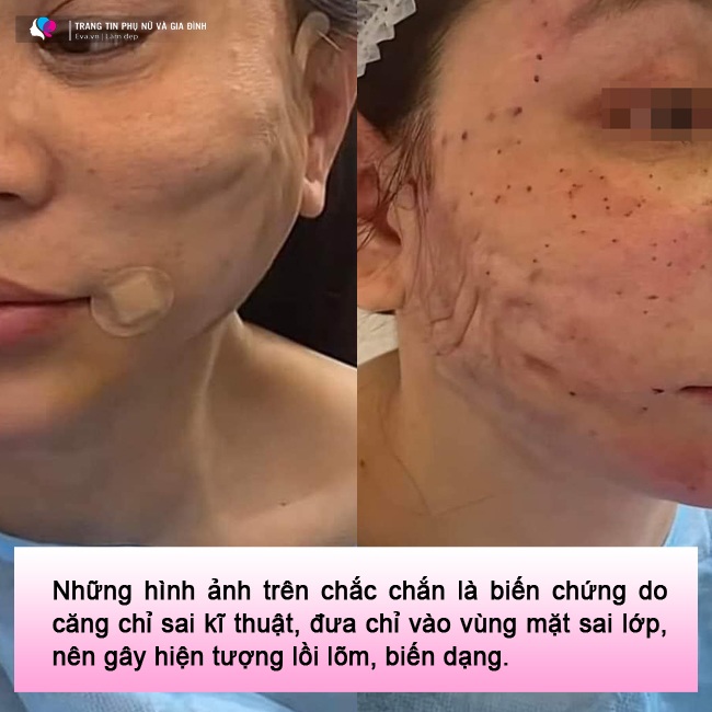 amp;#34;Lạnh gáyamp;#34; những pha cấy chỉ căng da của chị em trung niên, đẹp chưa thấy, ngắm đã xót - 10