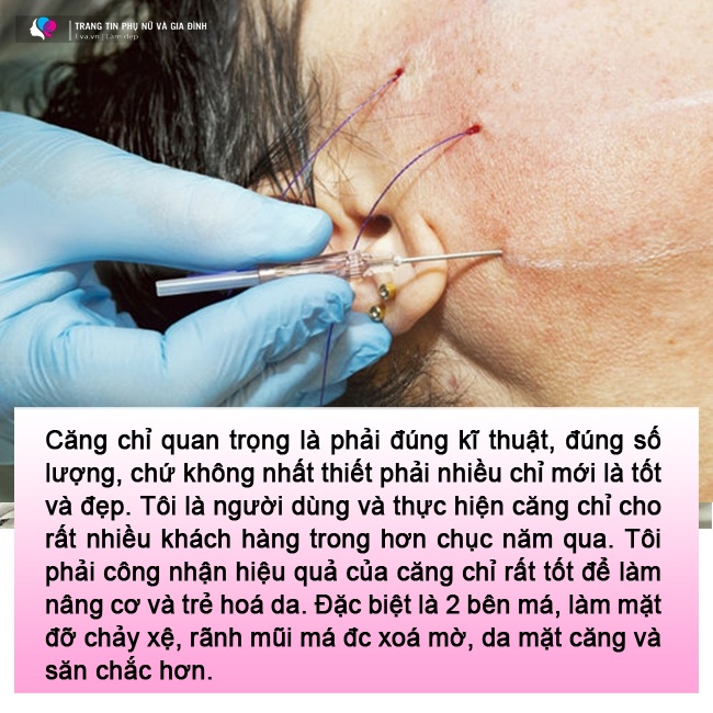 amp;#34;Lạnh gáyamp;#34; những pha cấy chỉ căng da của chị em trung niên, đẹp chưa thấy, ngắm đã xót - 12