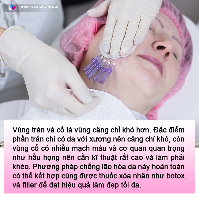 amp;#34;Lạnh gáyamp;#34; những pha cấy chỉ căng da của chị em trung niên, đẹp chưa thấy, ngắm đã xót - 13