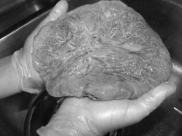 Đẻ xong 2 tháng, mẹ trẻ hốt hoảng khi đi vệ sinh thấy nhau thai rơi ra từ cơ thể