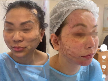 Lạnh gáy những pha cấy chỉ căng da của chị em trung niên, đẹp chưa thấy, ngắm đã xót
