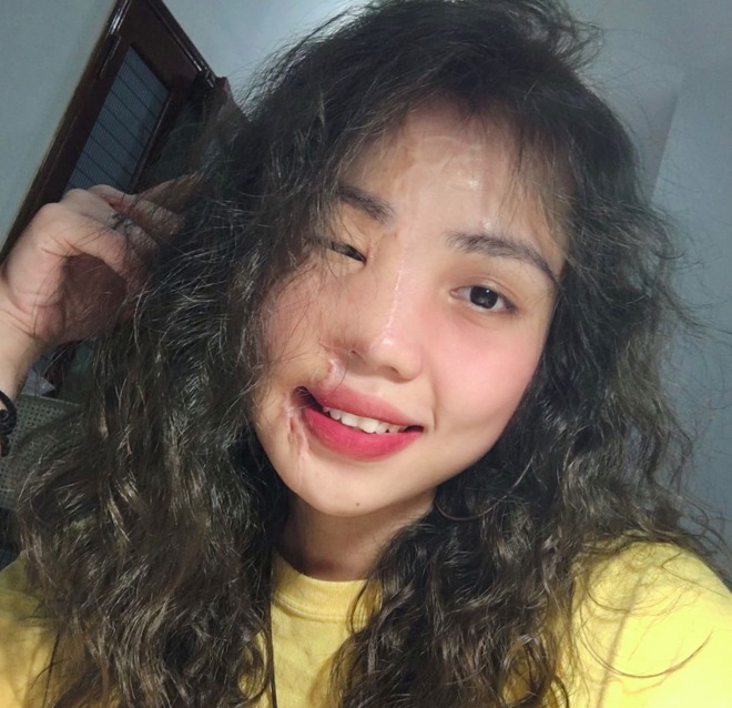 Bất ngờ cuộc sống mới của cô gái Đà Nẵng bị chồng sắp cưới tạt axit, hình ảnh hiện tại gây ngỡ ngàng - 1