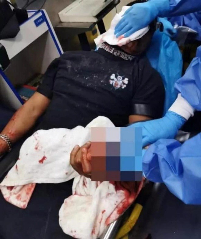 Anh mới bị chém vào mặt và phải khẩu 100 mũi.