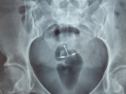 Bà bầu - Khi vòng tránh thai không chịu nằm đúng chỗ, “đi du lịch” vào thành bụng, bàng quang