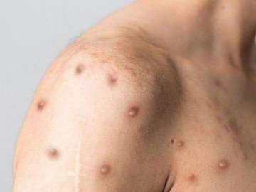 TP.HCM ghi nhận trường hợp mắc đậu mùa khỉ thứ hai