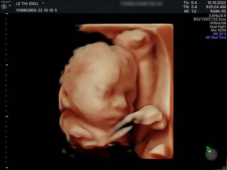 Cặp đôi chồng 1m37 lấy vợ 1m62: Cưới 1 tháng có tin vui, nửa đêm nghén khế chồng cũng đi hái ngay - 5