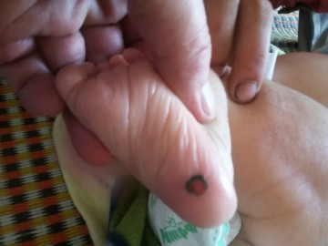 Vừa sinh ra 20 bé sơ sinh đã mắc giang mai, nguyên nhân từ chính sự chủ quan của mẹ khi mang bầu