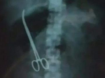 Sau sinh mổ lần 3 thường xuyên bị đau bụng, đi khám thì phát hiện bác sĩ bỏ quên kéo trong bụng