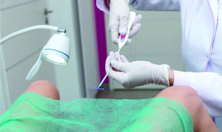 Có lẽ ít phụ nữ đã biết, tùy theo mỗi loại vòng tránh thai mà cũng có thời gian sử dụng nhất định (Ảnh minh họa)