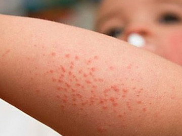 Cách phân biệt COVID-19, cúm và sốt xuất huyết