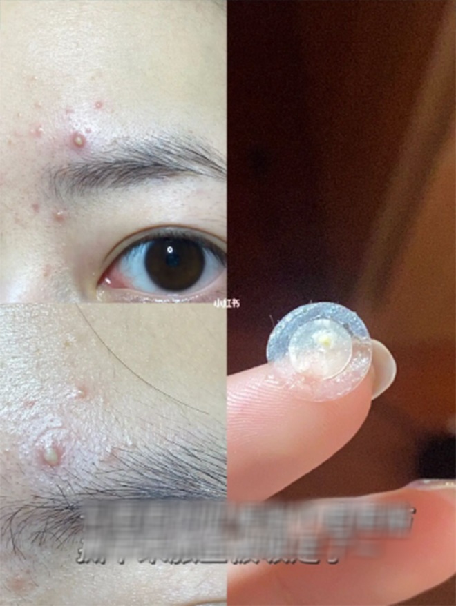 Nhiều người tự hỏi việc makeup quá nhiều có khiến tình trạng mụn của cô nàng trầm trọng hơn không. Được biết, người đẹp này đã dùng một tips khá độc đáo đó là dùng miếng dán mụn che phần cồi mụn lại để tránh bị nhiễm trùng trước khi thực hiện những bước makeup sau.