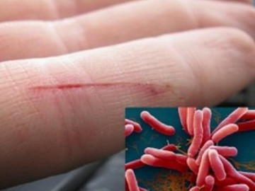 Bé trai Thanh Hóa nhiễm "vi khuẩn ăn thịt người" tử vong trong tình trạng suy đa tạng, hoại tử ruột