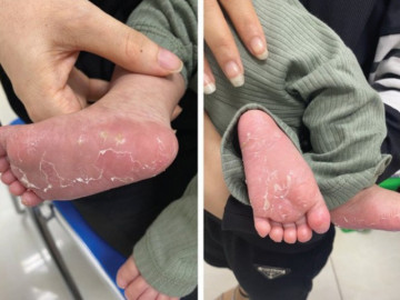 Bé sơ sinh liên tục quấy khóc và bong da tay chân, nhận kết quả bố mẹ ngỡ ngàng vì mắc bệnh xã hội
