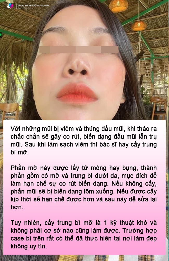 Đòi lấy sụn tai bạn trai nâng mũi, gái xinh làm cõi mạng lao đao, bác sĩ trả lời thế nào? - 9