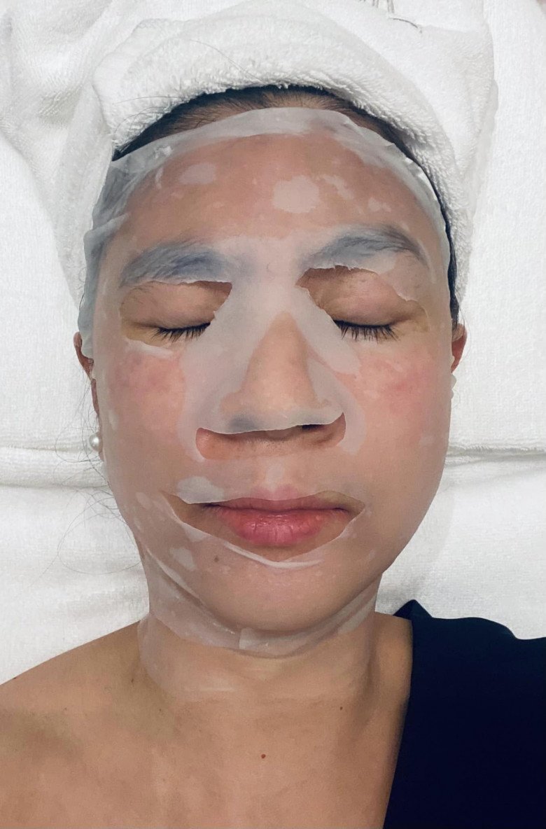 Cô từng phải đi bắn laser trị nám để lấy lại làn da đều màu. Người đẹp bị chân nám rất rõ ở vùng gò má. Thực tế, nám không gây ảnh hưởng tới sức khỏe của phái nữ nhưng lại khiến cho làn da mất tính thẩm mỹ vì các sắc tố đậm màu.