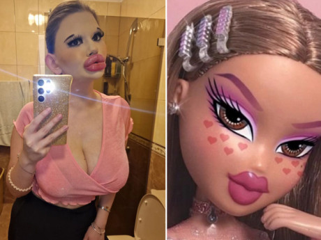 Muốn giống búp bê, cô gái chi hơn 200 triệu đồng bơm môi đến 32 lần, nhìn kết quả mà "sốc"