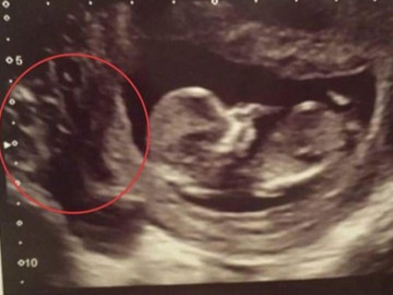 Mẹ bầu khóc ngất khi siêu âm thấy có nhiều   hố đen   ở nhau thai và quyết định bất ngờ