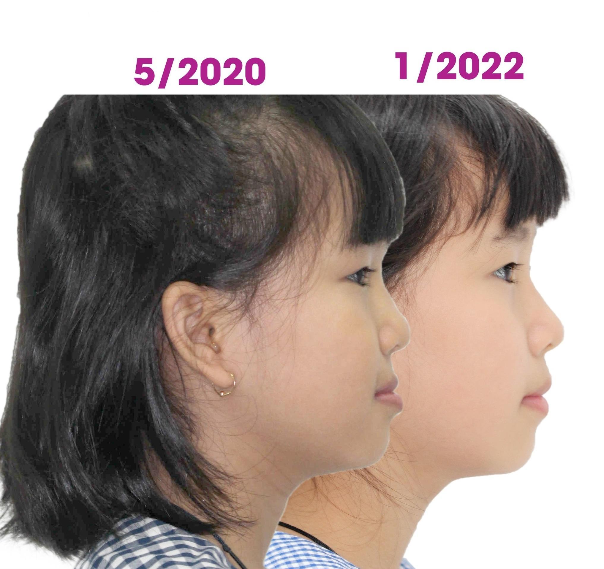 Hình ảnh tương quan môi trên và môi dưới thay đổi sau một thời gian bé đeo khí cụ Facemask.