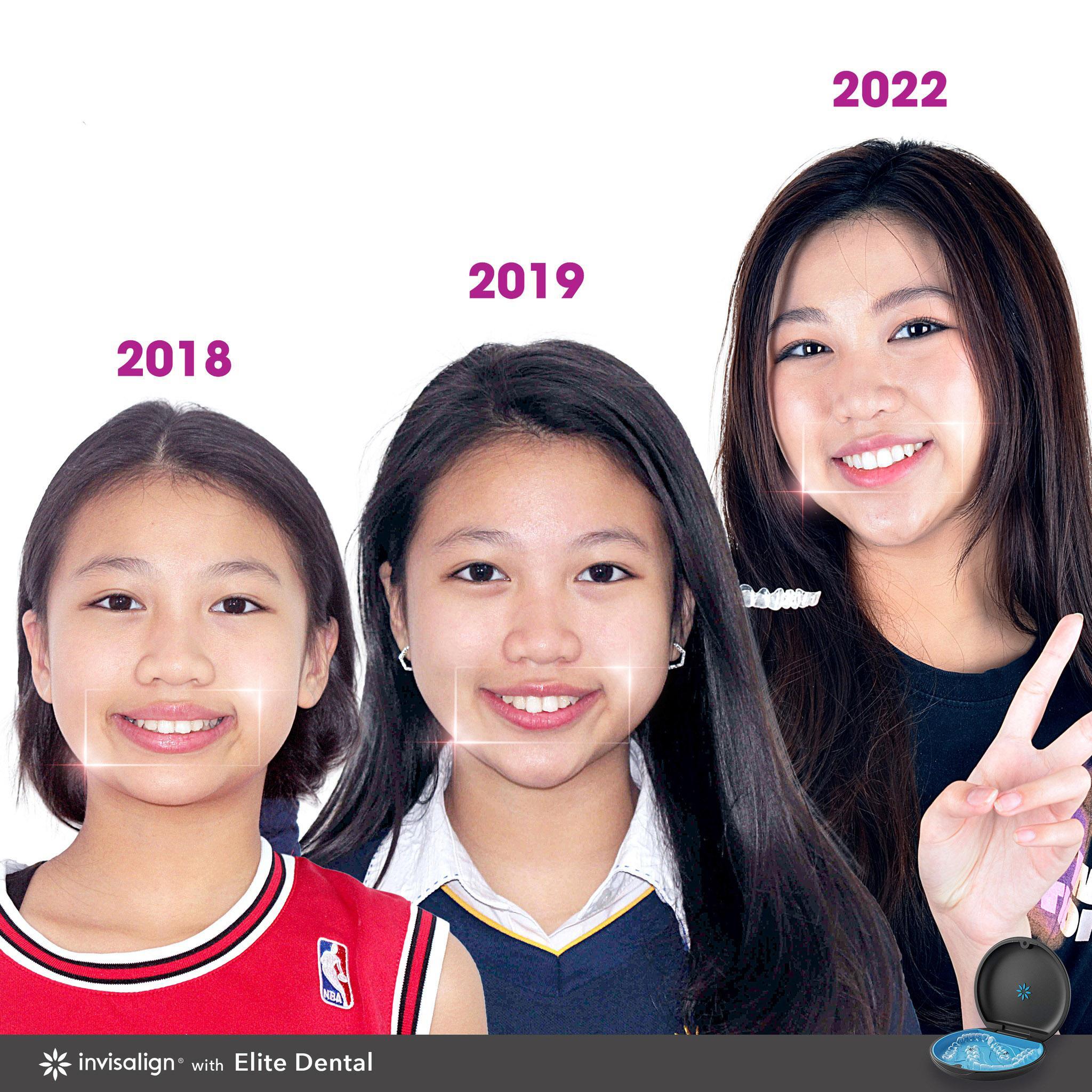 Niềng răng là “bí kíp” an toàn để hoàn thiện đường thẩm mỹ cho phái đẹp mà không cần tới “dao kéo”.