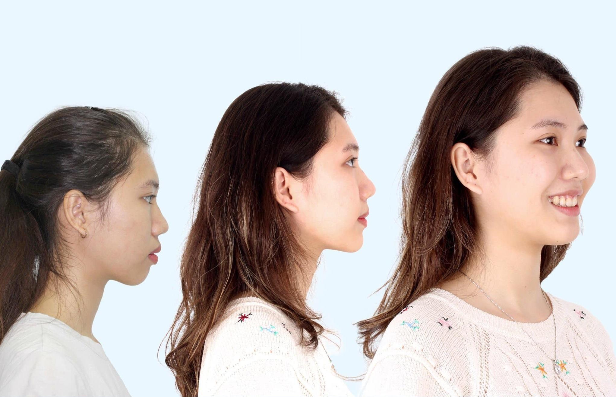 Chỉnh nha thành công giúp T.Th thay đổi thẩm mỹ khuôn mặt, nét nhìn nghiêng hài hòa.