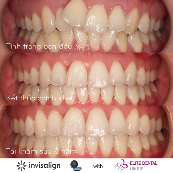 Kết thúc sau niềng răng phải đảm bảo khớp cắn đúng, răng lồng múi với nhau, đường giữa chính xác, ăn nhai và phát âm tốt.