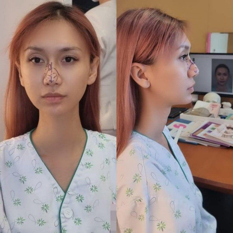 Chia sẻ lí do quyết tâm thực hiện nâng mũi lần này, Lynk Lee bộc bạch bản thân đã từng phẫu thuật khá nhiều, nhưng cô vẫn chưa ưng mũi của mình lắm. Do đó ở lần sửa này, cô lại tiếp tục trông cậy cơ sở thẩm mỹ uy tín để làm lại một chiếc mũi xinh xắn và mềm mại hơn.