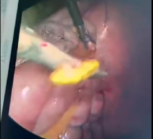 Hình ảnh bác sĩ lấy con giun từ trong lòng ruột thừa bệnh nhân ra ngoài. Ảnh: BSCC.