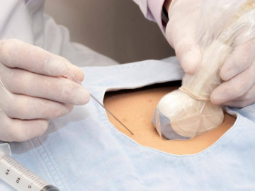 Vì sao nhiều mẹ bầu khi khám thai bác sĩ chỉ định phải sinh thiết gai nhau?
