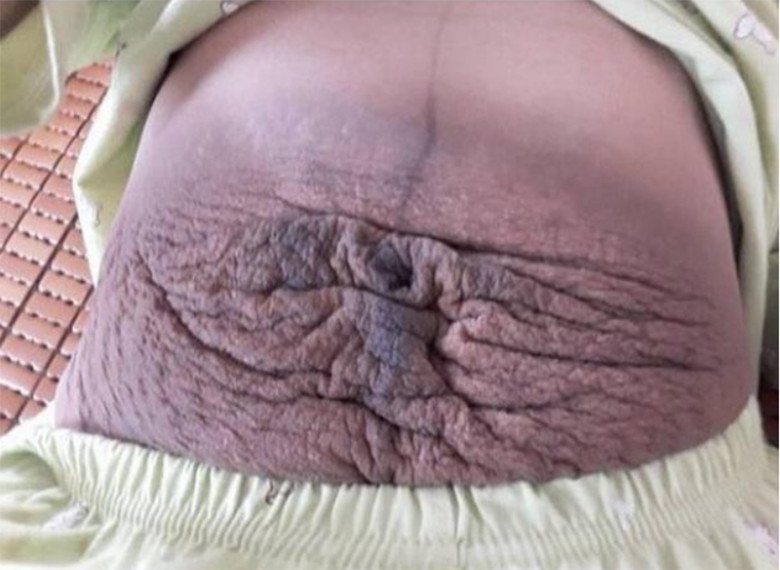 Bụng của vợ tôi sau thời gian mang thai đã bị rạn tóe loe, da thì bèo nhèo. Nhìn mà tôi xót xa quá. (Ảnh minh họa)