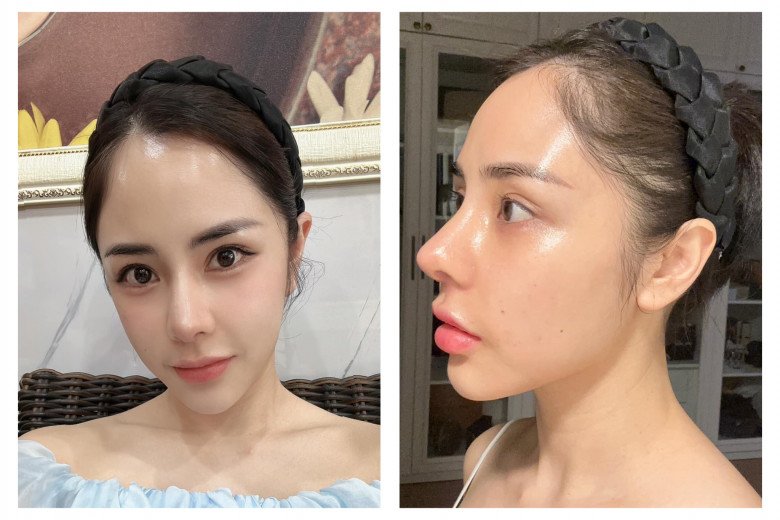 ​​​​​Đến hiện tại, mũi của nữ MC sinh năm 1986 đã hoàn toàn hồi phục. Người đẹp VTV nhận về nhiều lời khen với chiếc mũi mới vì trông đã hài hoà hơn với gương mặt của cô. 