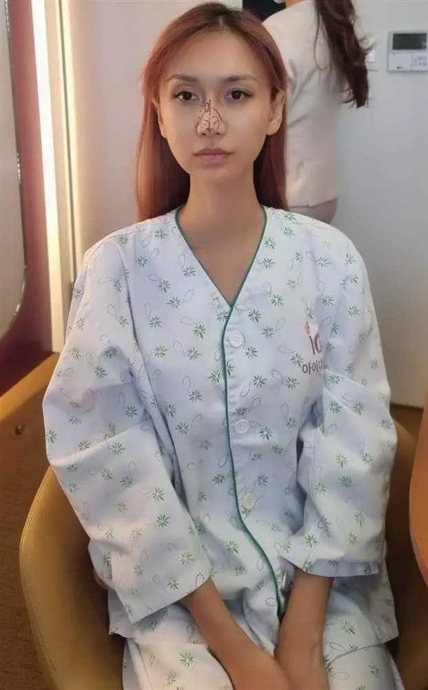 Không chỉ chi hơn 300 triệu để thay đổi giọng nói, trong năm 2022, Lynk Lee cũng thực hiện sửa mũi lần 2.