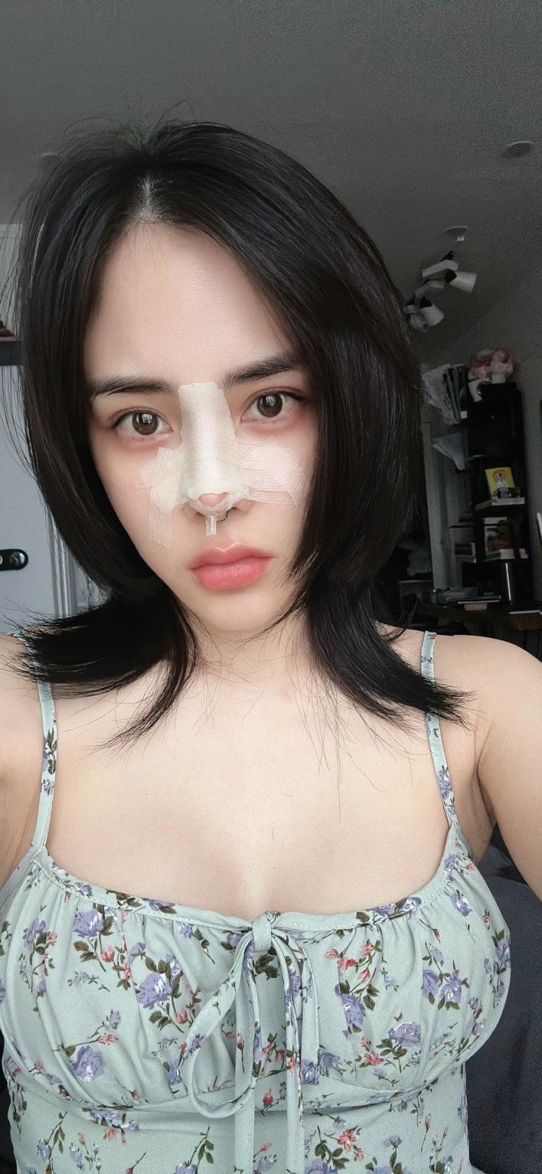 Bạn gái Huỳnh Anh cho biết đã tốn hàng trăm triệu để sửa sai cho chiếc mũi của mình.