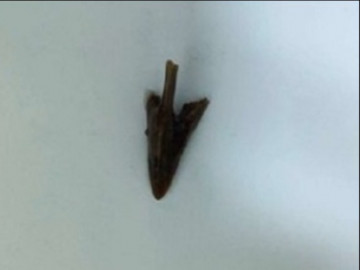 Ăn thịt gà bị sặc, một tháng sau người đàn ông Hà Nội được tìm thấy chiếc mỏ gà trong cơ thể